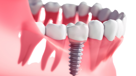 The Role of Vitamin D in Dental Implant Success